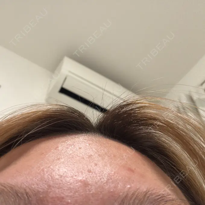 ボトックス（眉間） / ボトックス（額） / その他（鼻） TCB東京中央美容外科 姫路院 DAY 0 メイン用