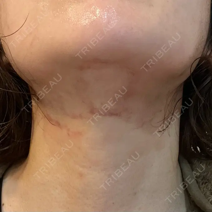 ピコレーザートーニング（美白・肝斑） / ピコフラクショナルレーザー（毛穴・ニキビ跡） / インモード 東京美容皮膚科アロエクリニック池袋 DAY 1 メイン用