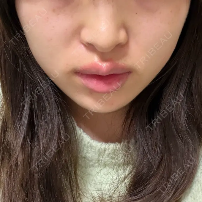 ボトックス（あご） / ボトックス（エラ・小顔） / ボトックス（口角） ルラ美容クリニック 神戸院 DAY 5 メイン用