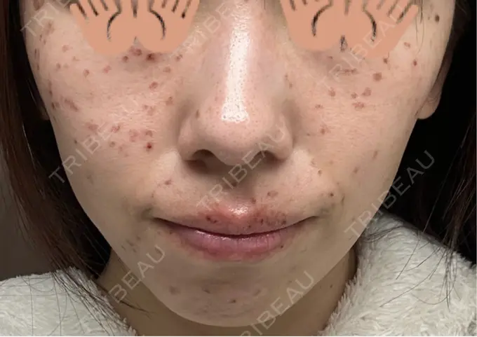 ピコレーザートーニング（美白・肝斑） / ピコスポット 東京シルククリニック 東京神田院 DAY 4 メイン用