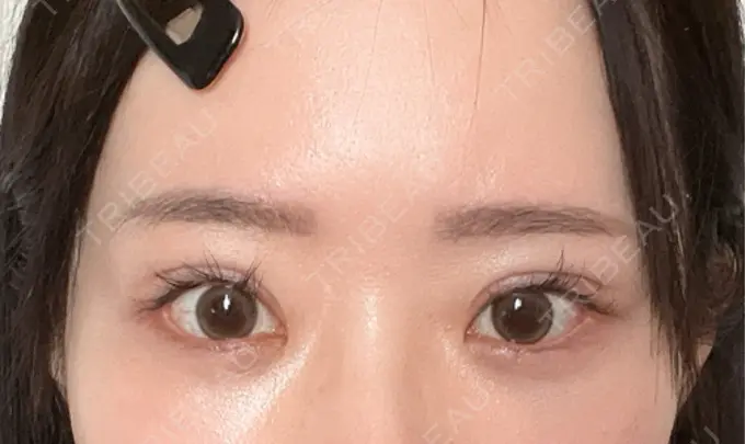 クマ治療 / 下まぶたの脂肪取り / 脂肪注入（目の下） ルラ美容クリニック 渋谷本院 AFTER メイン用