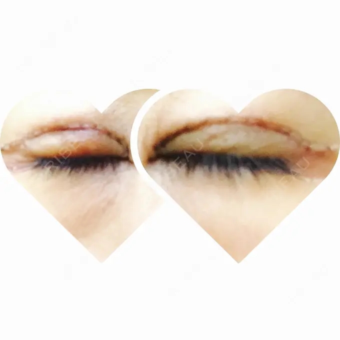 眼瞼下垂（切開） ブリスクリニック形成外科・美容外科・美容皮膚科 福岡 DAY 3 メイン用