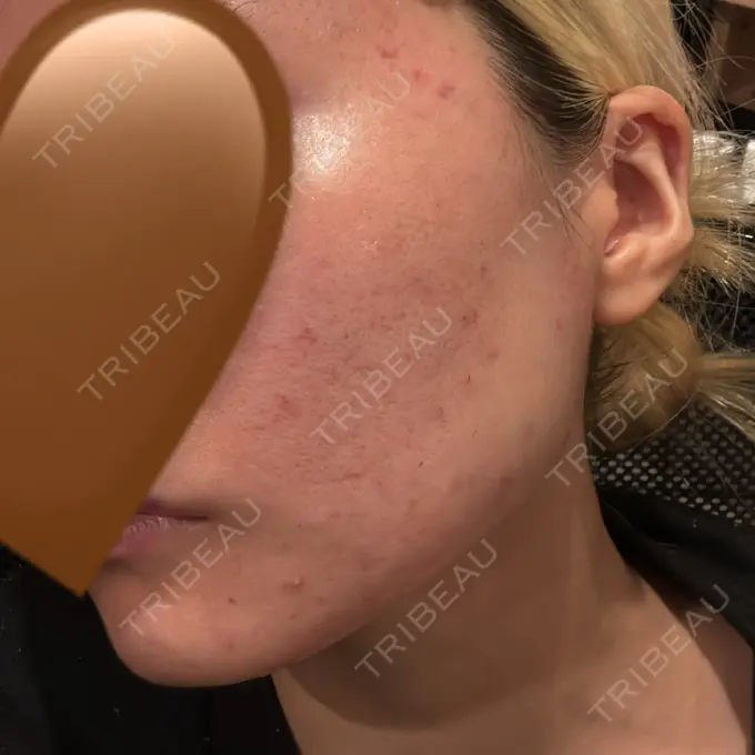 肌育注射（ジュベルックなど） / エレクトロポレーション ハナビューティークリニック DAY 0 メイン用