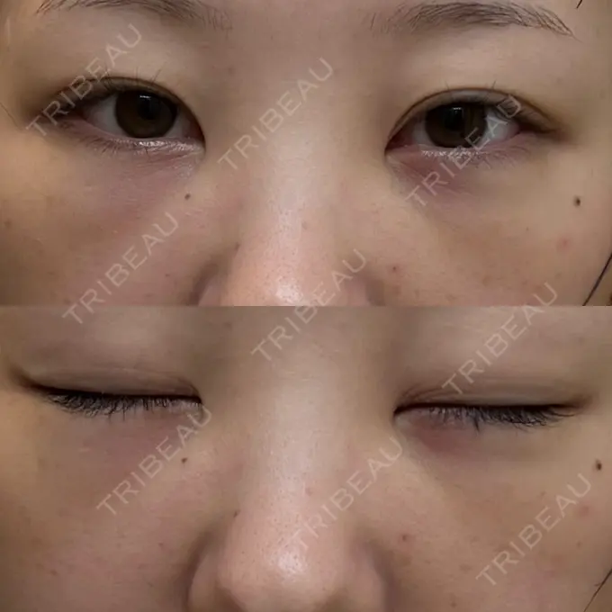 クマ治療 / 脂肪注入（目の下） 湘南美容クリニック 千葉センシティ院 DAY 7 メイン用