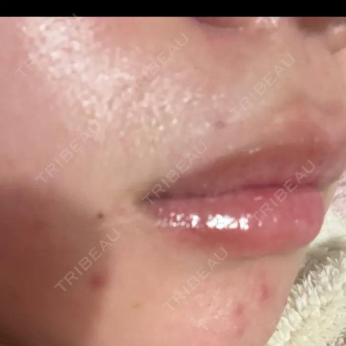 ほくろ・いぼ切除（肌） R Beauty CLINIC 名古屋院 DAY 19 メイン用