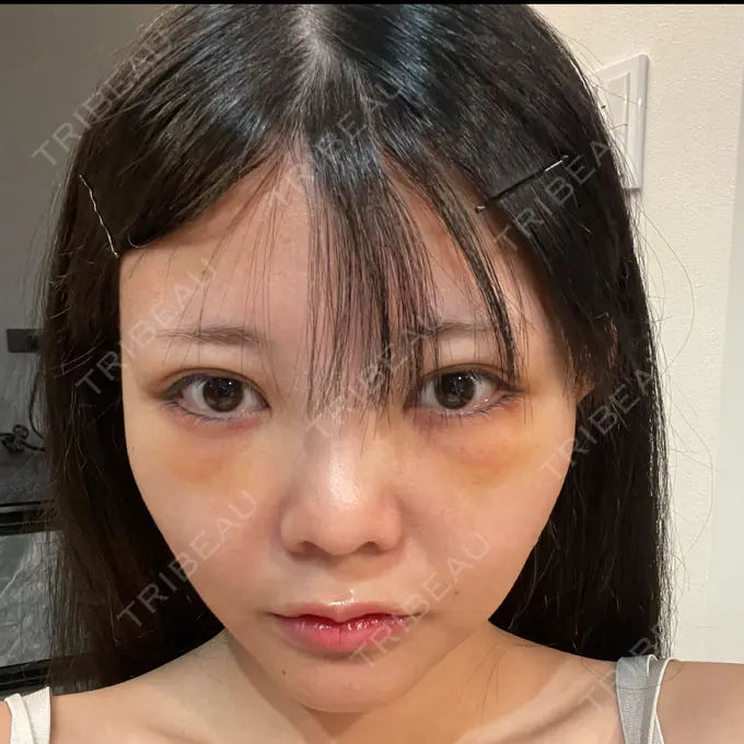 クマ治療 あじまビューティークリニック DAY 3 メイン用