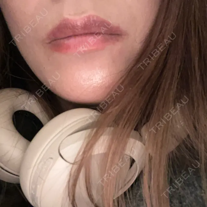 ボトックス（口角） / ボトックス（額） メディカルアルファクリニック AFTER メイン用