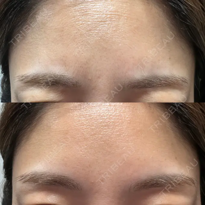 ボトックス（眉間） ルラ美容クリニック 高田馬場院 AFTER メイン用