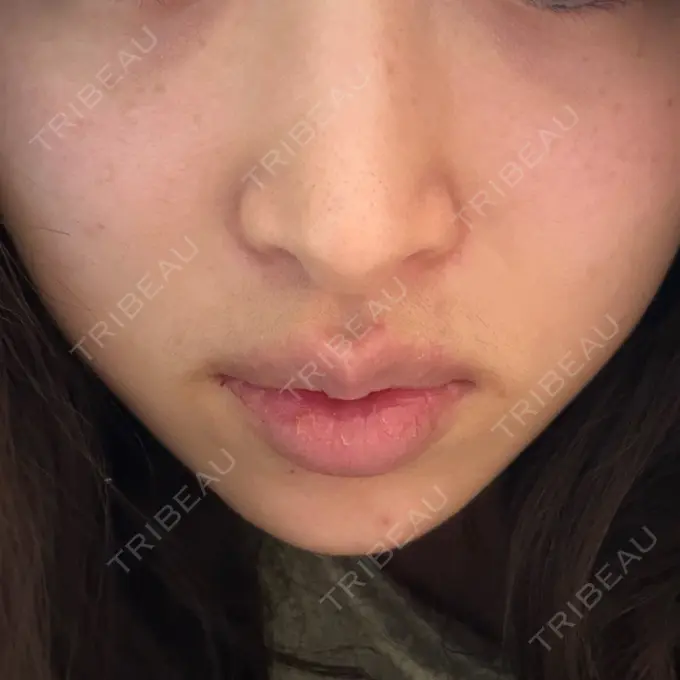 ボトックス（あご） / ボトックス（エラ・小顔） / ボトックス（口角） ルラ美容クリニック 神戸院 DAY 6 メイン用