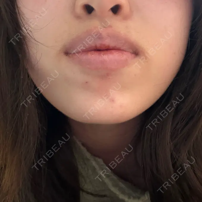 ボトックス（あご） / ボトックス（エラ・小顔） / ボトックス（口角） ルラ美容クリニック 神戸院 DAY 6 メイン用