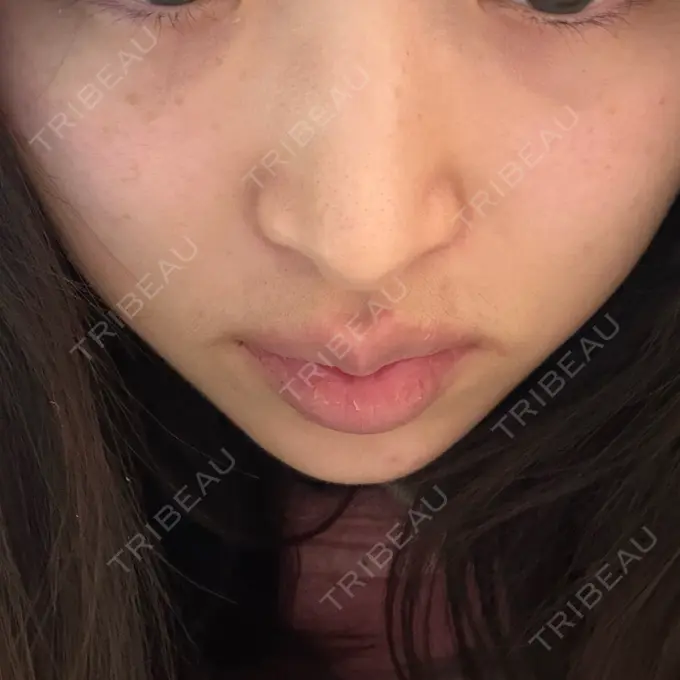 ボトックス（あご） / ボトックス（エラ・小顔） / ボトックス（口角） ルラ美容クリニック 神戸院 DAY 7 メイン用