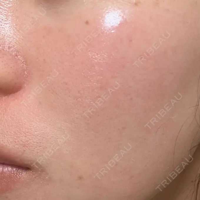 水光注射（ハリ・美肌） 城本クリニック 姫路院 AFTER メイン用