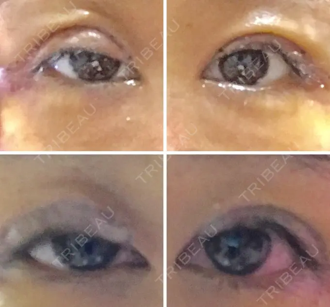 眼瞼下垂（切開） ブリスクリニック形成外科・美容外科・美容皮膚科 福岡 DAY 4 メイン用