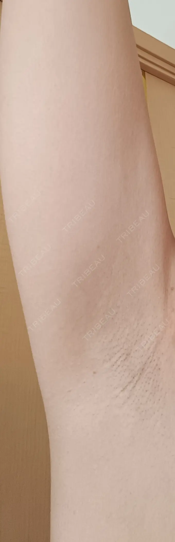 ワキ汗治療（レーザー） フォンタナクリニック天神 AFTER メイン用