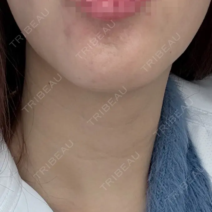 アグネス 日本美容・医療クリニック 六本木院 AFTER メイン用