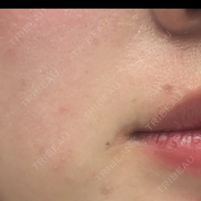 ほくろ・いぼ切除（肌） R Beauty CLINIC 名古屋院 DAY 20 メイン用