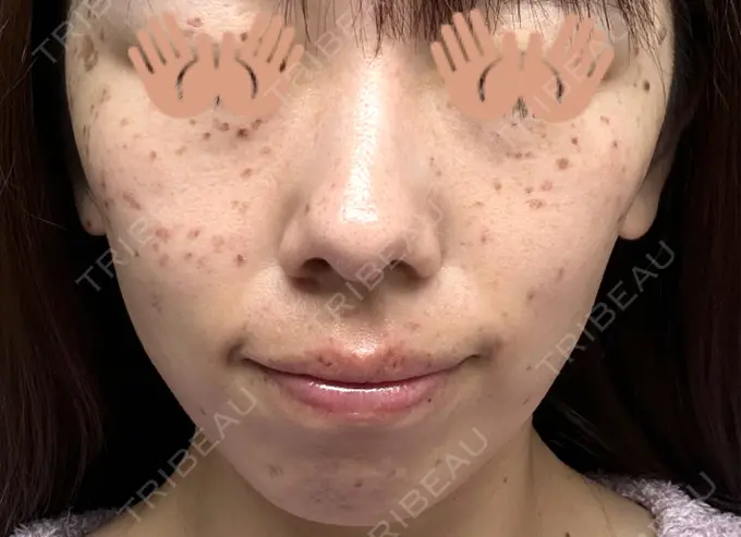 ピコレーザートーニング（美白・肝斑） / ピコスポット 東京シルククリニック 東京神田院 DAY 4 メイン用