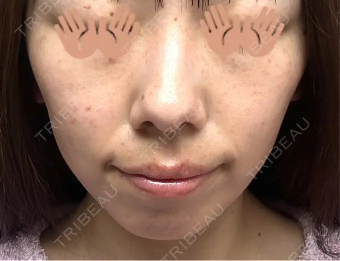 ピコレーザートーニング（美白・肝斑） / ピコスポット 東京シルククリニック 東京神田院 DAY 6 メイン用