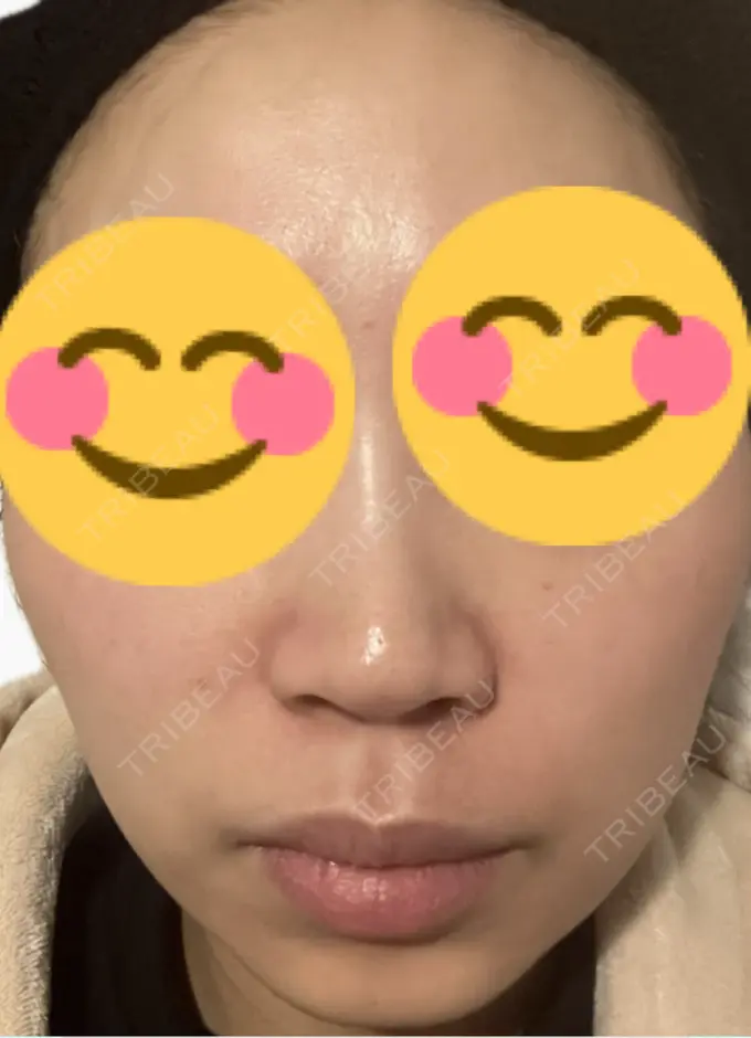 脂肪溶解注射（顔） 吉祥寺アイビークリニック DAY 1 メイン用