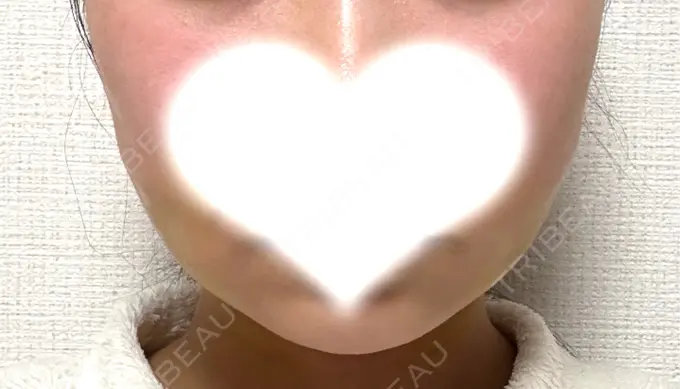 糸リフト / 脂肪吸引（顔） / ジョールファット除去 アリエル美容クリニック 水戸院 DAY 6 メイン用