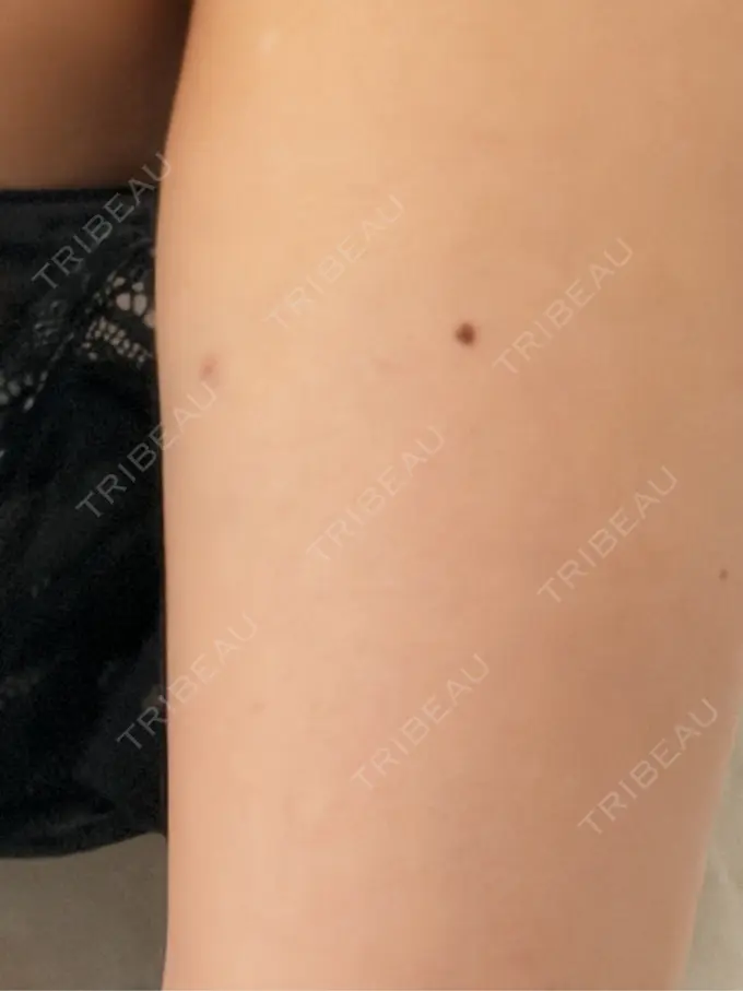 脂肪溶解注射（二の腕） 吉祥寺アイビークリニック AFTER メイン用