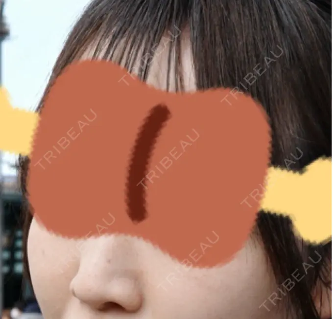 ルメッカ ルラ美容クリニック 名古屋栄院 / ルラスキンクリニック 名古屋栄院 DAY 15 メイン用