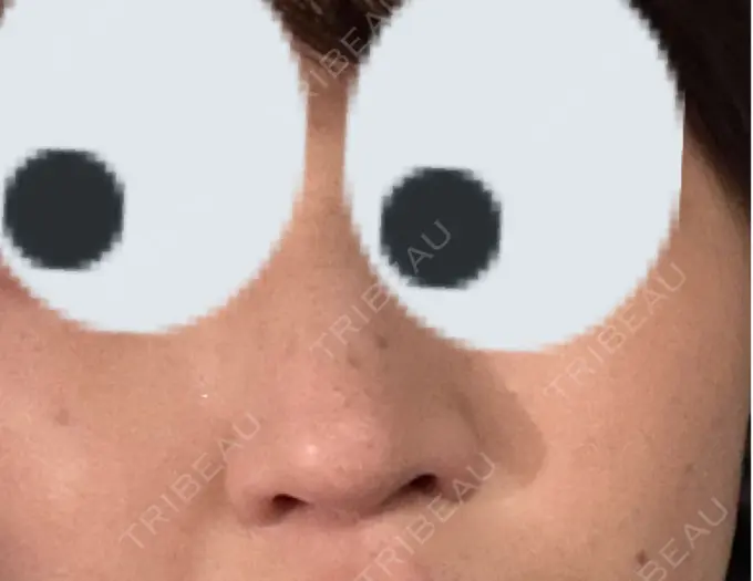 ルメッカ ルラ美容クリニック 名古屋栄院 / ルラスキンクリニック 名古屋栄院 DAY 18 メイン用