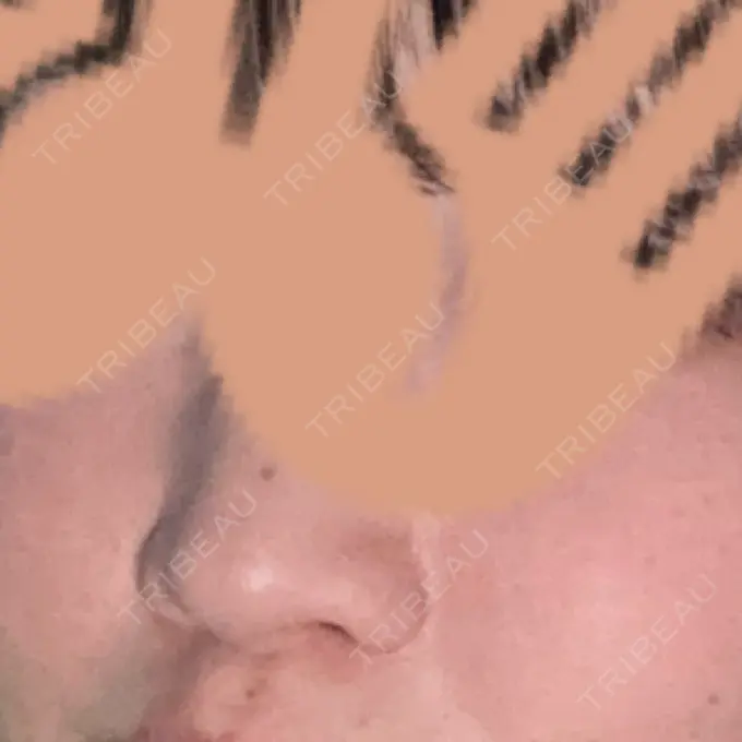 ルメッカ ルラ美容クリニック 名古屋栄院 / ルラスキンクリニック 名古屋栄院 DAY 11 メイン用