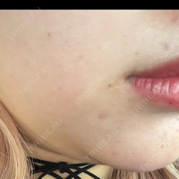 ほくろ・いぼ切除（肌） R Beauty CLINIC 名古屋院 AFTER メイン用