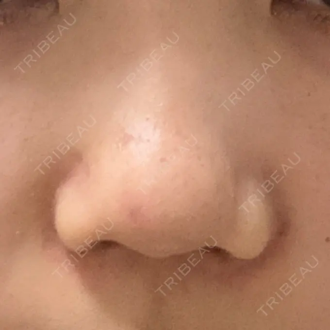 シワ取りボトックス ルラ美容クリニック 池袋院 DAY 0 メイン用