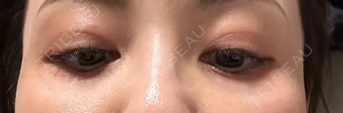 ボトックス（目尻） TCB東京中央美容外科 三島院 AFTER メイン用