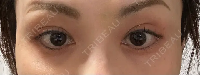 ボトックス（目尻） TCB東京中央美容外科 三島院 DAY 9 メイン用