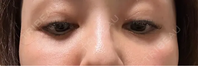 ボトックス（目尻） TCB東京中央美容外科 三島院 DAY 8 メイン用