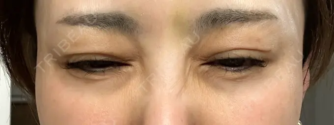 ボトックス（目尻） TCB東京中央美容外科 三島院 DAY 7 メイン用