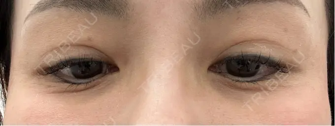 ボトックス（目尻） TCB東京中央美容外科 三島院 DAY 5 メイン用