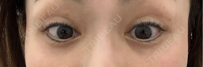 ボトックス（目尻） TCB東京中央美容外科 三島院 DAY 4 メイン用