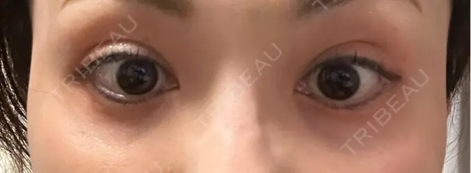 ボトックス（目尻） TCB東京中央美容外科 三島院 DAY 3 メイン用