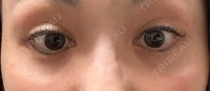 ボトックス（目尻） TCB東京中央美容外科 三島院 DAY 2 メイン用