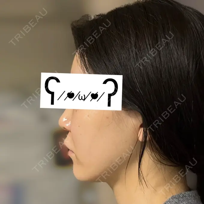 その他（肌） / オンダリフト ライブリークリニック 大阪院 DAY 0 メイン用