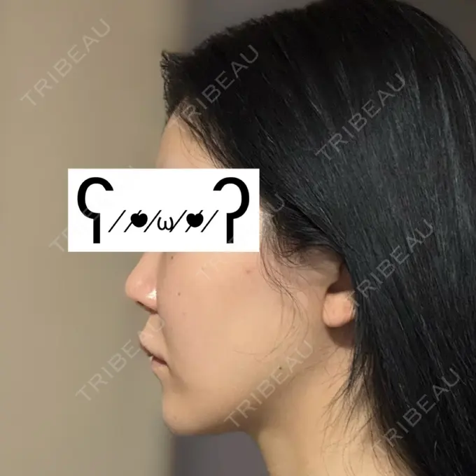 その他（肌） / オンダリフト ライブリークリニック 大阪院 DAY 4 メイン用