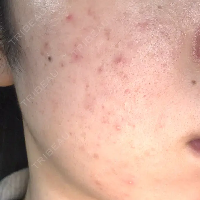 イオン導入 / 毛穴洗浄（ハイドラフェイシャルなど） / ルメッカ 東京シルククリニック 東京神田院 AFTER メイン用