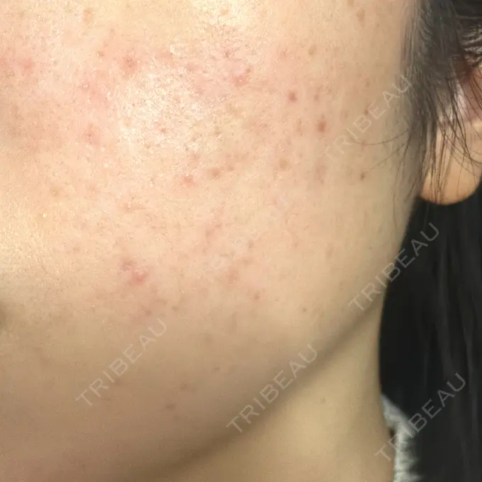 イオン導入 / 毛穴洗浄（ハイドラフェイシャルなど） / ルメッカ 東京シルククリニック 東京神田院 DAY 70 メイン用