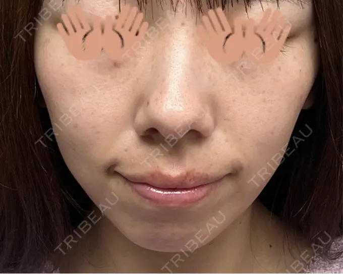 ピコレーザートーニング（美白・肝斑） / ピコスポット 東京シルククリニック 東京神田院 AFTER メイン用