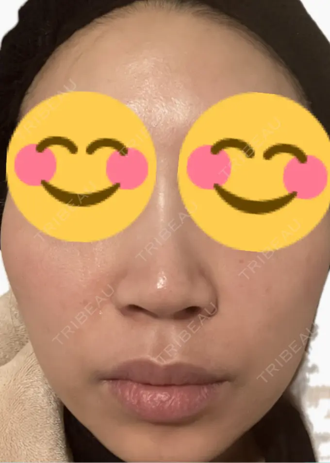 脂肪溶解注射（顔） 吉祥寺アイビークリニック DAY 2 メイン用