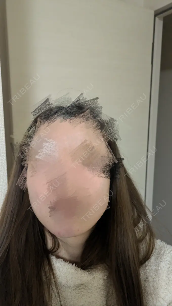 ヒアルロン酸注入（あご） TCB東京中央美容外科 青森院 AFTER メイン用