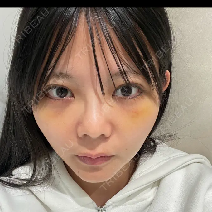 クマ治療 あじまビューティークリニック DAY 6 メイン用