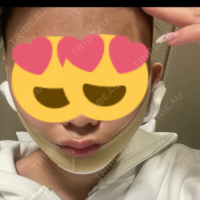 糸リフト / あご下筋肉縛り WOM CLINIC GINZA （ワム クリニック ギンザ） DAY 0 メイン用