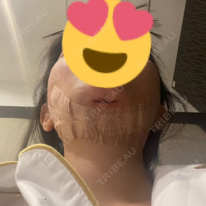 糸リフト / あご下筋肉縛り WOM CLINIC GINZA （ワム クリニック ギンザ） DAY 0 メイン用