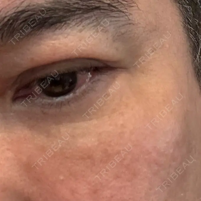 水光注射（ハリ・美肌） Natural Skin Clinic 笹塚院 AFTER メイン用