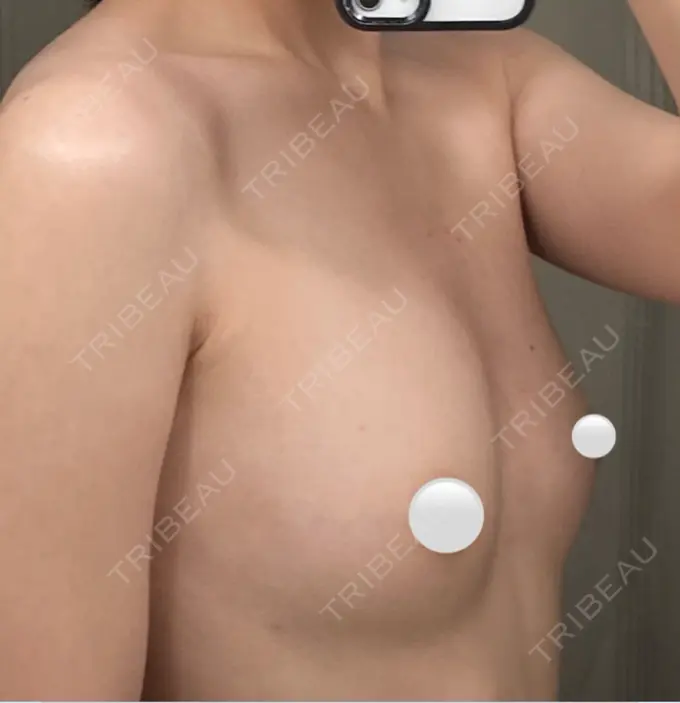 豊胸（脂肪注入） ルーチェクリニック 銀座院 DAY 56 メイン用